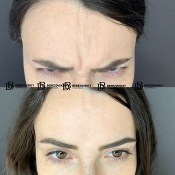 Ботокс чоло + міжбрів'я
оригінальний препарат Botox
тривал
