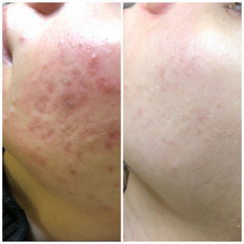 Біоревіталізація
                    Косметолог-ін'єкціоніст Іванна Калуш