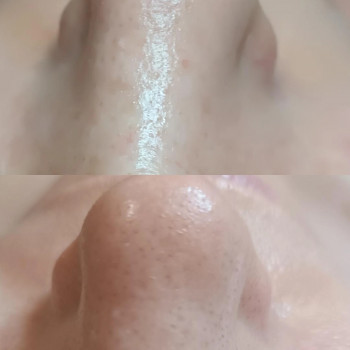 Чистка обличчя
                    Косметолог Людмила Бровари