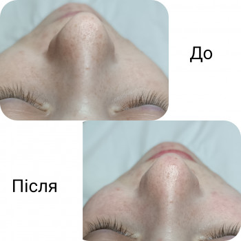 Чистка обличчя
                    Косметолог Людмила Бровари