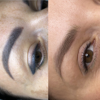 Видалення повік- після 2 процедур. Брови- після курсу компле