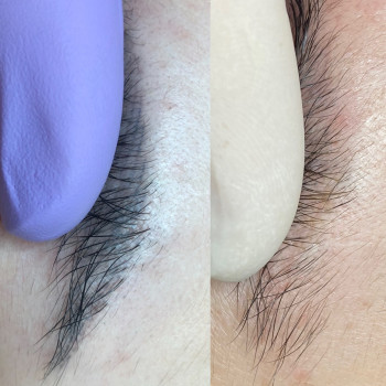 Лазерне видалення - результат після 2 процедур.