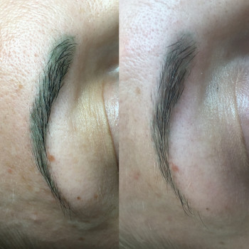 BioRemover - результат після 2 процедур.