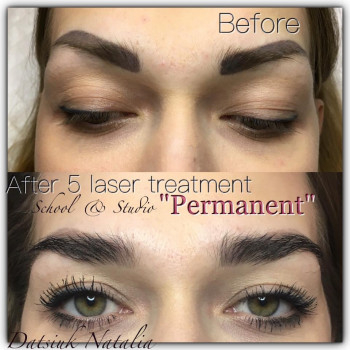 Лазерне видалення - результат після 5 процедур.