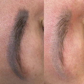 Відразу після лазерного видалення пм брів.