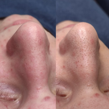 Комбінована чистка обличчя
                    Косметолог Людмила Киев