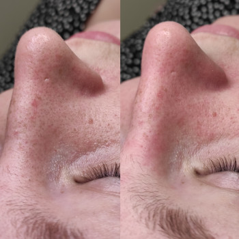 Комбінована чистка обличчя
                    Косметолог Людмила Киев