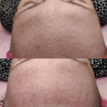 Комбінована чистка обличчя
                    Косметолог Людмила Киев