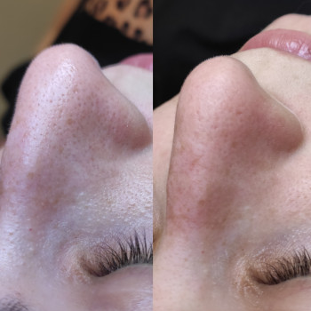 Комбінована чистка обличчя
                    Косметолог Людмила Киев