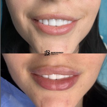 Контурная пластика
                    Пластический хирург Дмитрий Березовский Киев