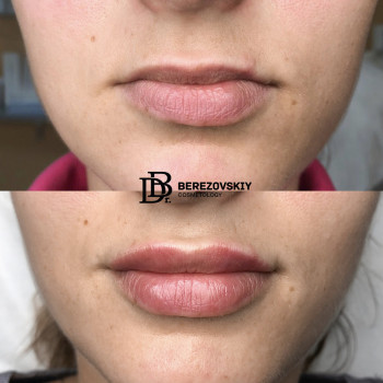 Контурная пластика
                    Пластический хирург Дмитрий Березовский Киев