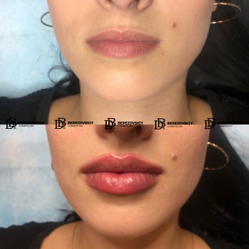 Контурная пластика
                    Пластический хирург Дмитрий Березовский Киев