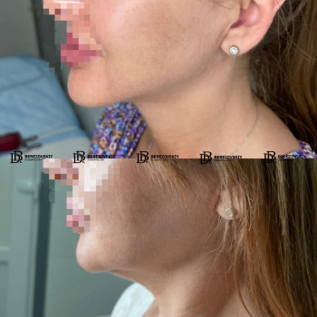 Ліпосакція підборіддя