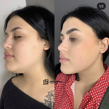 Ліпосакція підборіддя