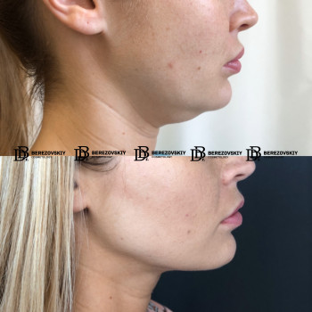Ліпосакція підборіддя