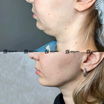 Ліпосакція підборіддя