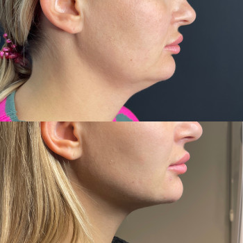 Ліпосакція підборіддя та брилів