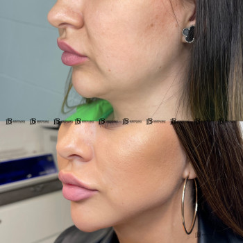 Ліпосакція підборіддя з видаленням комків Біша