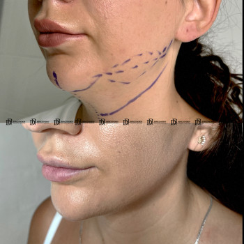 Ліпосакція підборіддя