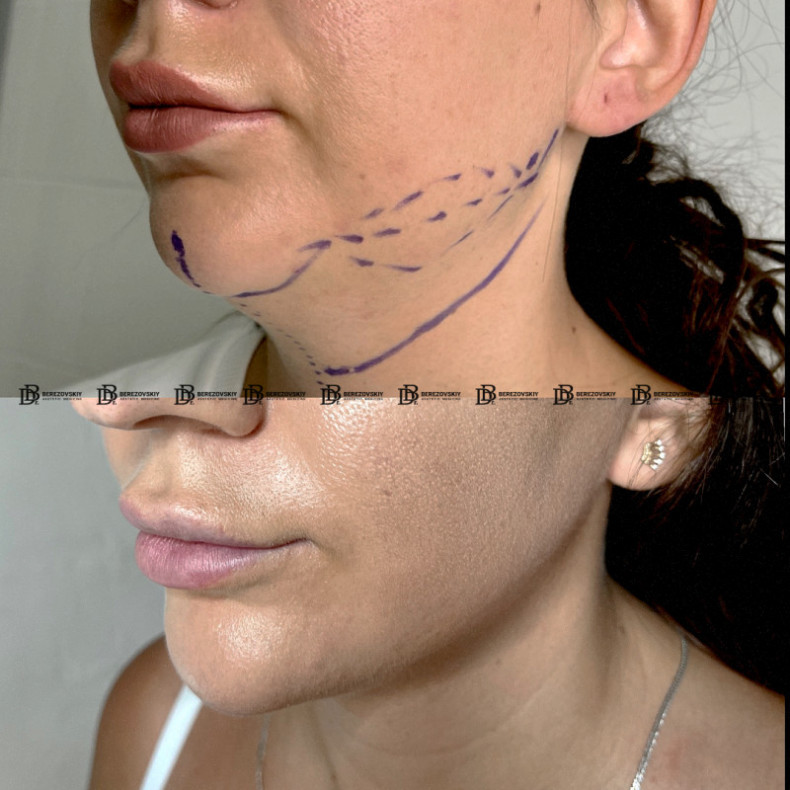 Ліпосакція підборіддя, фото - Пластический хирург Дмитрий Березовский
