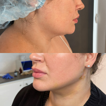 Ліпосакція підборіддя