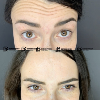Ботокс чола + міжбрів'я