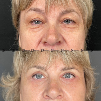 Кругова блефаропластика