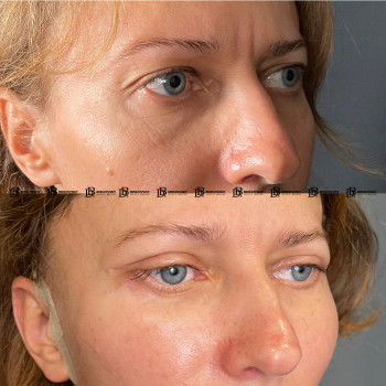 Кругова блефаропластика