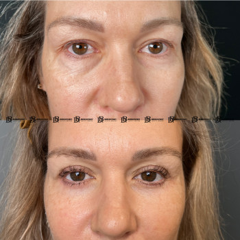 Кругова блефаропластика з ліпофілінгом