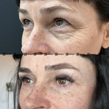 Кругова блефаропластика з ліпофілінгом