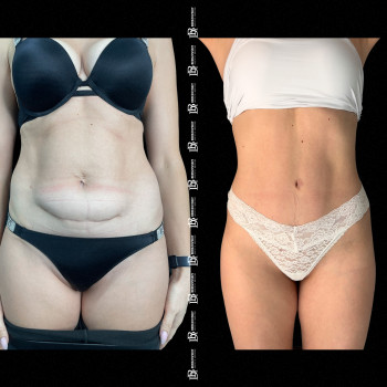 Абдомінопластика з ліпосакцію боків