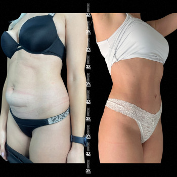 Абдомінопластика з ліпосакцію боків