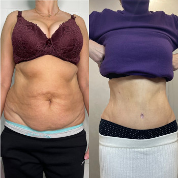 Абдомінопластика з ліпосакцію боків