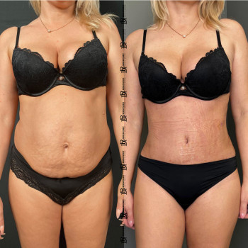 Абдомінопластика з ліпосакцію боків