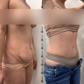 Абдомінопластика з ліпосакцію боків