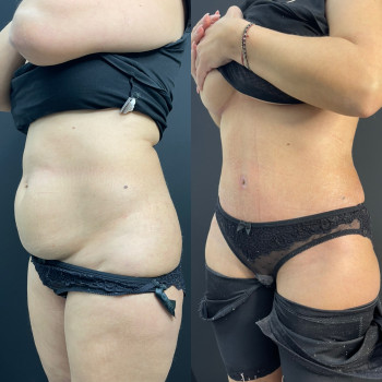 Абдомінопластика з ліпосакцію боків