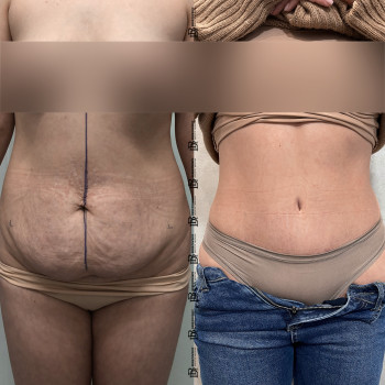 Абдомінопластика з ліпосакцію боків