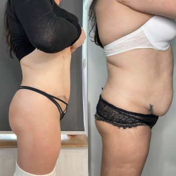 Абдомінопластика з ліпосакцію боків