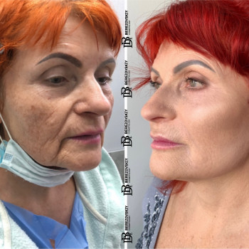 Кругова підтяжка обличчя + блефаропластика