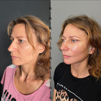 Кругова підтяжка обличчя + блефаропластика