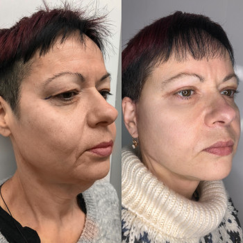 Кругова підтяжка обличчя та шиї + блефаропластика