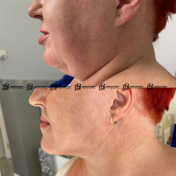 Кругова підтяжка обличчя та шиї