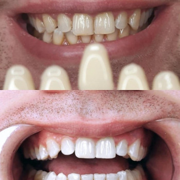 Отбеливание зубов на 8 тонов!