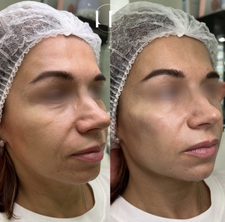 Біорепарація + ліфтинг, фото - Лікар-косметолог Наталія Рибчинська