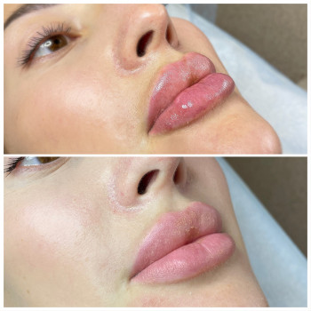 Контурна пластика губ.