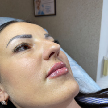 Аугментація губ