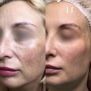 PDRN полінуклеотиди
                    Врач-косметолог Наталия Киев