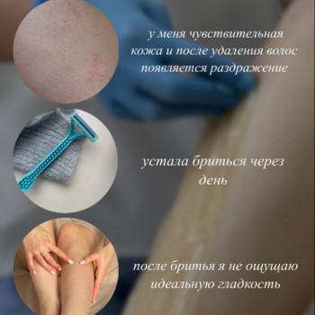 депиляция, лазерная эпиляция