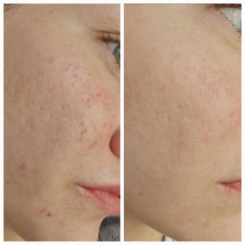 Інтелектуальний пілінг
                    Косметолог-ін'єкціоніст Надежда Київ