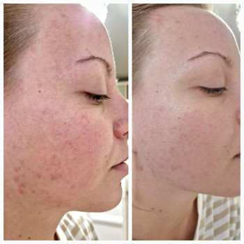 Інтелектуальний пілінг
                    Косметолог-ін'єкціоніст Надежда Київ